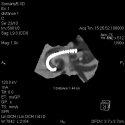 Human Cochlear Implant