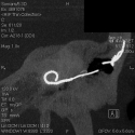 Human Cochlear Implant