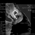 Human Cochlear Implant