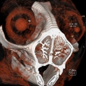 Ocular Malformation