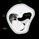 Pneumothorax